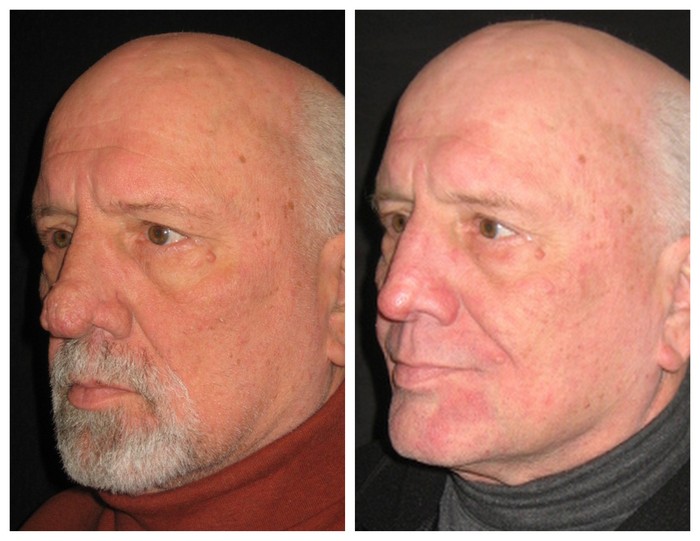 Rhinophyma or Red Bulbous Nose Treatment DC