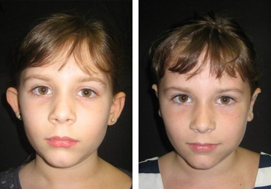 10609-front.jpg - Ear Pinning - Otoplasty - Before And After - Fairfax and Manassas VA
