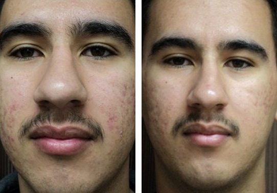 12622-front.jpg - Acne Treatment - Before and After | Fairfax and Manassas VA