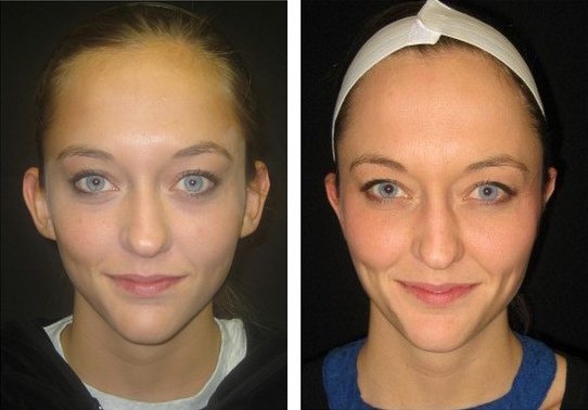 2460-Front.jpg - Ear Pinning - Otoplasty - Before And After - Fairfax and Manassas VA