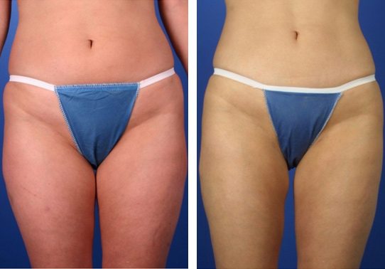 CX17.jpg - Liposuction - Before And After | Fairfax and Manassas VA