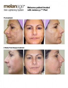 Bitar Institute - Managing Melasma