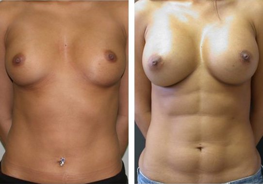 Patient-003a527105d07116e.jpg - Body Sculpting - Before and After | Fairfax and Manassas VA