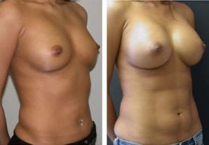 Patient-003b527105d0e6481.jpg - Body Sculpting - Before and After | Fairfax and Manassas VA
