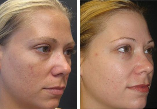 Patient-004a527014d90027c.jpg - Dermabrasion Before and After | Fairfax and Manassas VA