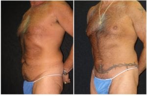 13538b.jpg - Body Sculpting - Before and After | Fairfax and Manassas VA