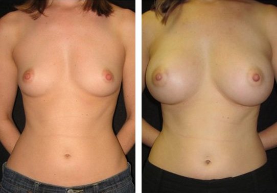 transaxillary breast augmentation before and after 340cc and 375cc