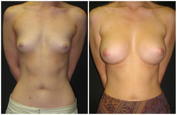 Transaxillary breast augmentation before and after 375cc