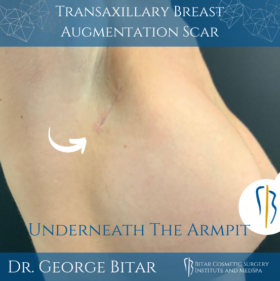 example of what a transaxillary breast augmentation scar could look like