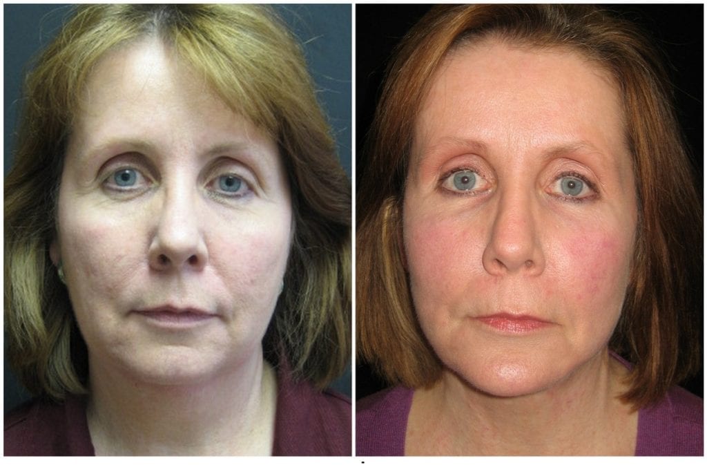 9958a53c591560e353.jpg - Neck Lift - Before and After | Fairfax and Manassas VA