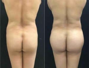 Example of V-shape buttocks