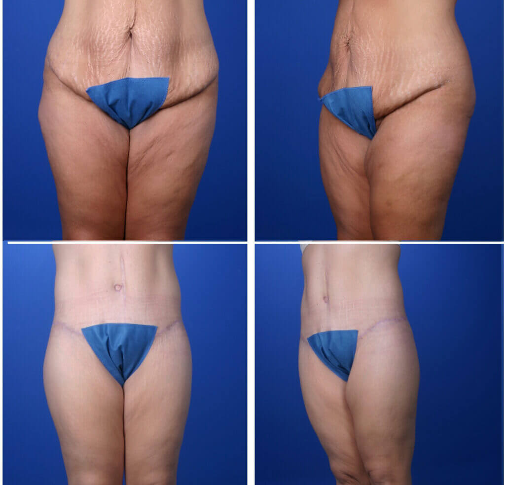 Bitar Institute Body-Contouring-After-Weight-Loss Delivers Long-Term Benefits To Patients