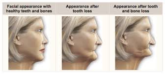 dental health facial aging