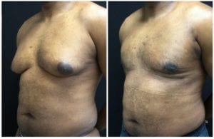 19451b.jpg - Male Breast Reduction - Before and After | Fairfax and Manassas VA