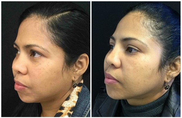 123a5665ea2b21d1b.jpg - Facial Cosmetic Procedure - Before and After | Fairfax and Manassas VA