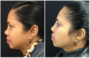 123b.jpg - Facial Cosmetic Procedure - Before and After | Fairfax and Manassas VA
