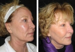 10210-sideview-non-surgical-facelift - Non-Surgical Cheek Augmentation - Before And After | Fairfax and Manassas VA