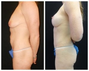 12465-Left-90 - Breast Lift Augmentation Before And After - Fairfax and Manassas VA