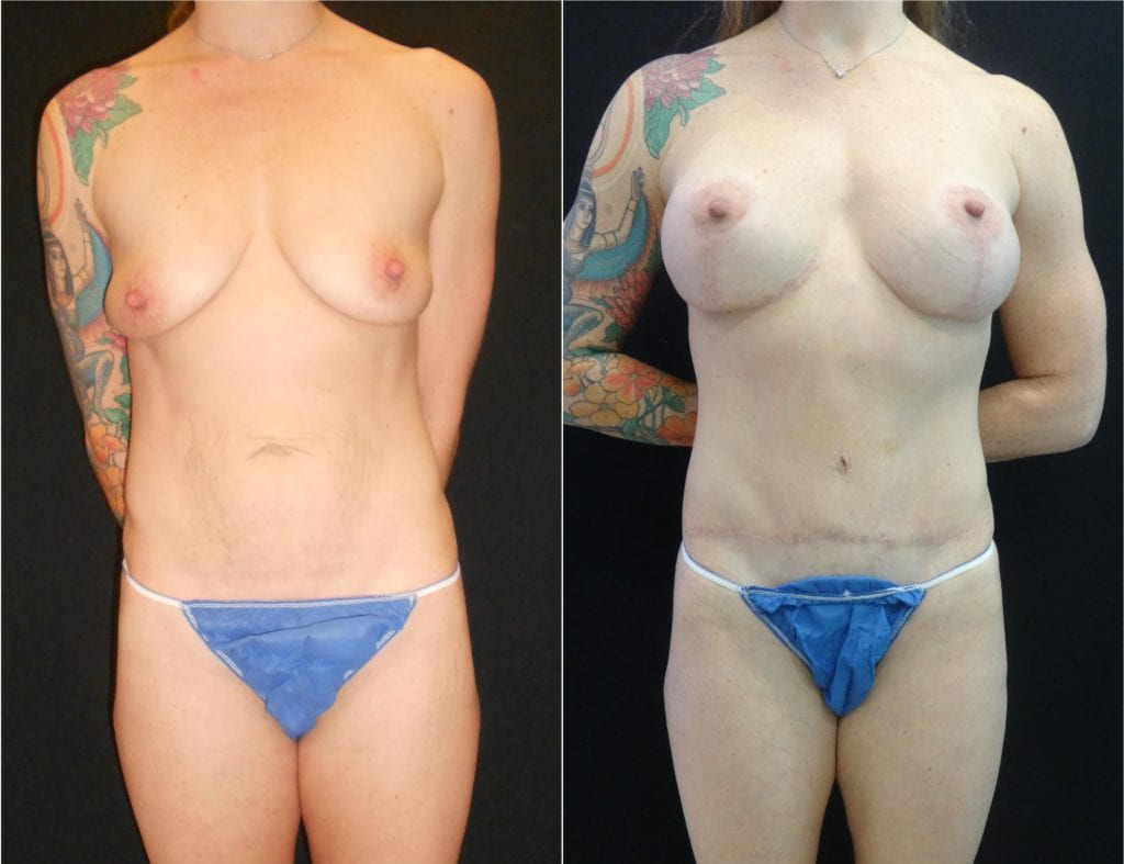 12465-front - Breast Lift Augmentation Before And After - Fairfax and Manassas VA