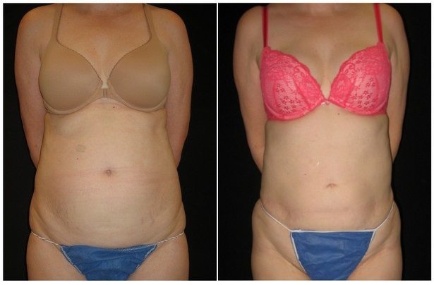 12502a - Laser Lipo Before and After | Fairfax and Manassas VA