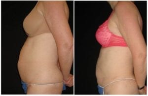 12502c - Laser Lipo Before and After | Fairfax and Manassas VA