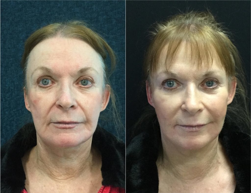 12793-beforeandafter-bellafill-1024x787 - Non-Surgical Cheek Augmentation - Before And After | Fairfax and Manassas VA