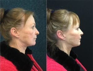 12793-side2-beforeandafter-bellafill-1024x787 - Non-Surgical Cheek Augmentation - Before And After | Fairfax and Manassas VA