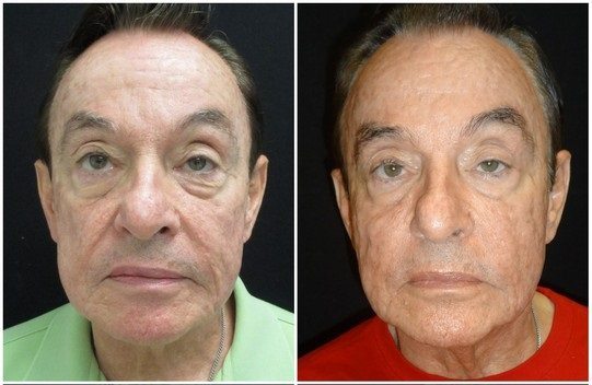 1427a-voluma - Non-Surgical Cheek Augmentation - Before And After | Fairfax and Manassas VA