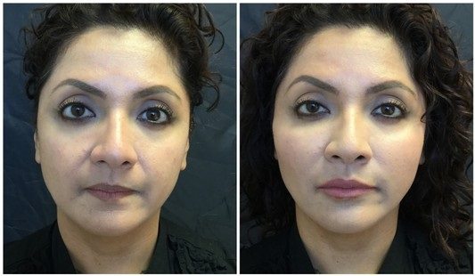 16287a-radiesse - Non-Surgical Cheek Augmentation - Before And After | Fairfax and Manassas VA