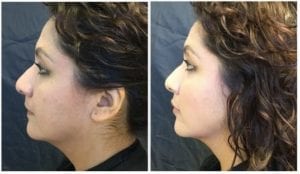 16287c-radiesse - Non-Surgical Cheek Augmentation - Before And After | Fairfax and Manassas VA