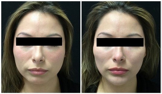 17073a-radiesse - Non-Surgical Cheek Augmentation - Before And After | Fairfax and Manassas VA