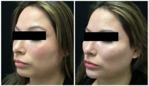 17073b58dead799f290-non-surgical-chin-augmentation - Non-Surgical Cheek Augmentation - Before And After | Fairfax and Manassas VA