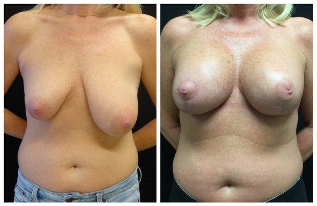 18277a - Breast Lift Augmentation Before And After - Fairfax and Manassas VA