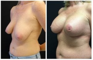 18277b - Breast Lift Augmentation Before And After - Fairfax and Manassas VA