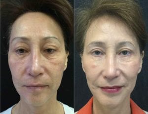 BBL Photo Rejuvenation - Before And After | Fairfax VA