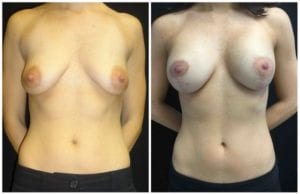 Breast Lift Augmentation Before And After - Fairfax and Manassas VA
