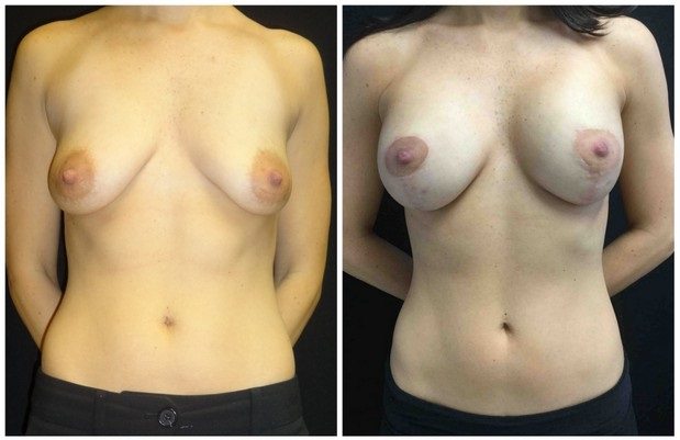 18790a - Breast Lift Augmentation Before And After - Fairfax and Manassas VA