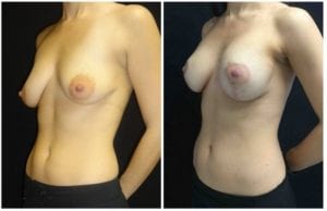 18790b - Breast Lift Augmentation Before And After - Fairfax and Manassas VA