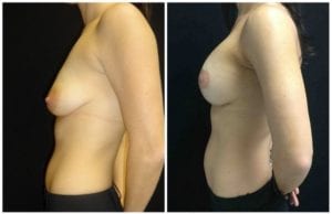 18790c - Breast Lift Augmentation Before And After - Fairfax and Manassas VA