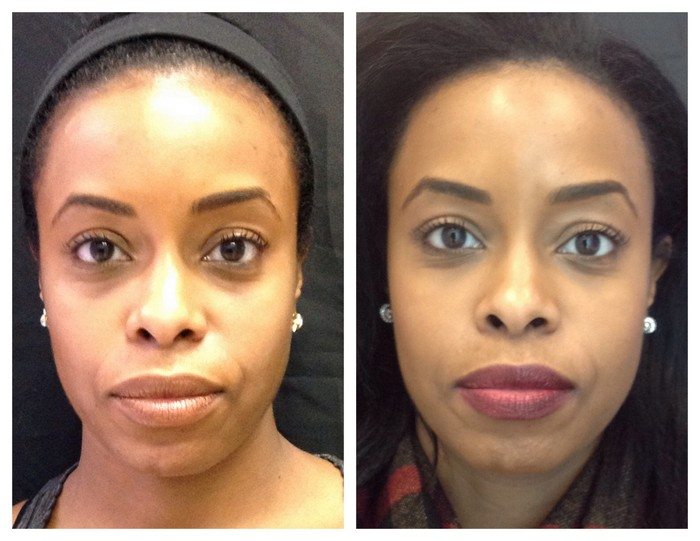 1920454e6970a0af2b-botox - Non-Surgical Cheek Augmentation - Before And After | Fairfax and Manassas VA