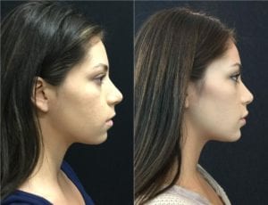 19335-20170310_Canvas(1) - Non-Surgical Cheek Augmentation - Before And After | Fairfax and Manassas VA