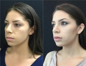 19335-20170310_Canvas(2) - Non-Surgical Cheek Augmentation - Before And After | Fairfax and Manassas VA