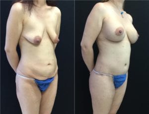 Breast Lift Augmentation - Before And After | Fairfax and Manassas VA