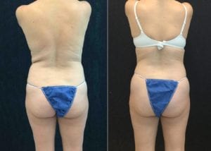 20680 BACK - CoolSculpting - Before And After - Fairfax and Manassas VA