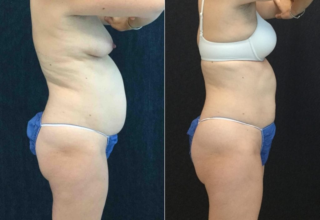 20680 PROFILE R - CoolSculpting - Before And After - Fairfax and Manassas VA