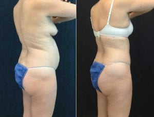 20680 R BACK ANGLE - CoolSculpting - Before And After - Fairfax and Manassas VA
