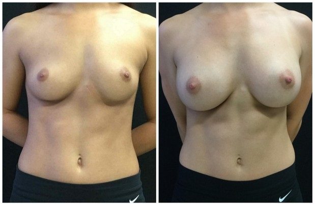 20731a - Breast Augmentation Before and After | Fairfax and Manassas VA