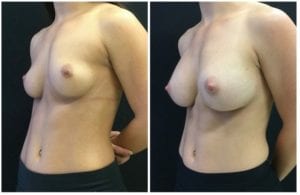 20731b - Breast Augmentation Before and After | Fairfax and Manassas VA
