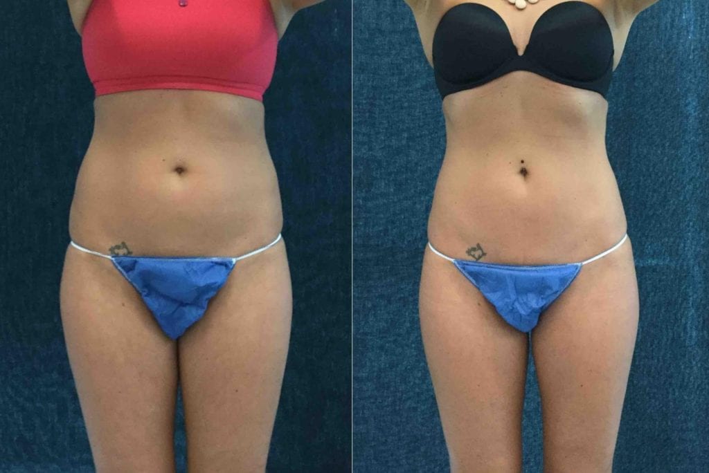 21597 FRONT - CoolSculpting - Before And After - Fairfax and Manassas VA