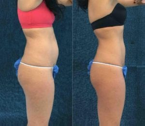 21597 R PROFILE - CoolSculpting - Before And After - Fairfax and Manassas VA